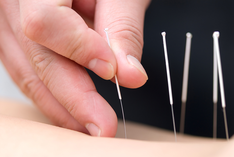 Do You Have Chronic Pain and You're Looking for Solutions— Acupuncture for Pain Management May Help